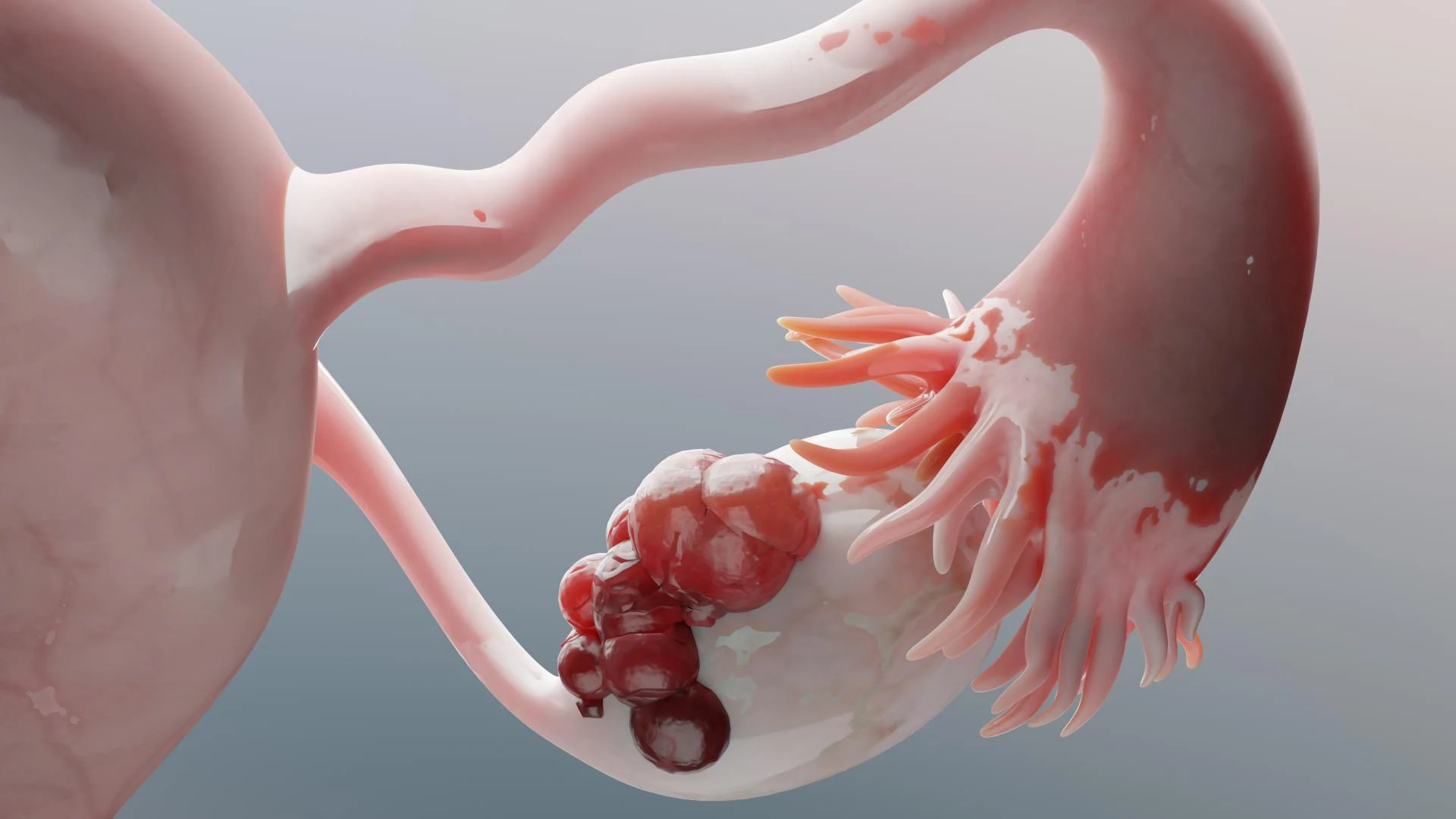 터지기 전까지 알 수 없는 난소낭종 — 차차여성의원 내몸이야기 이미지 1